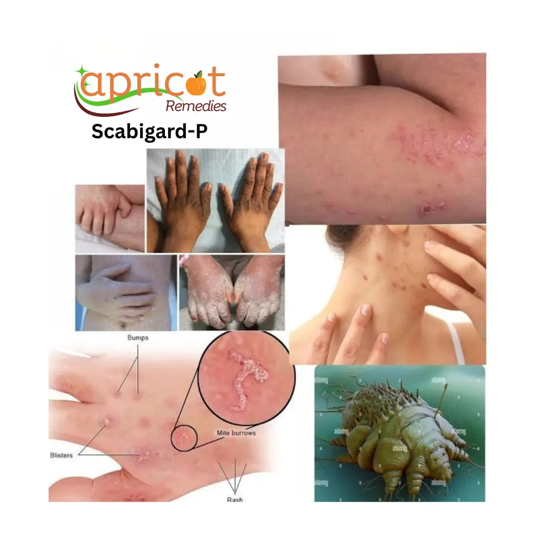 Scabstar Permethrin Cream for scabies 50ml (Pack of 4) Ultonio